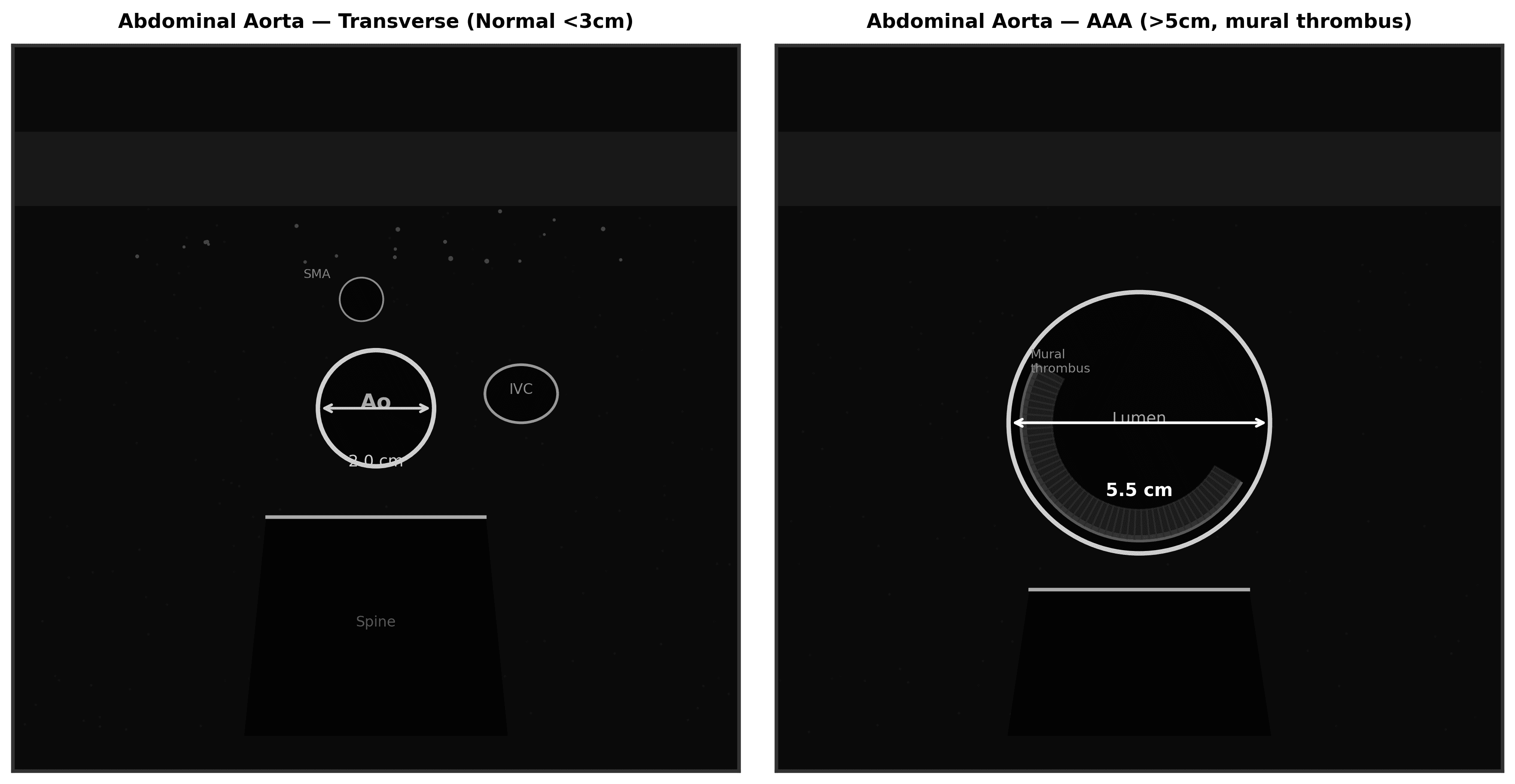 Abdominal Aorta (AAA) reference figure 1